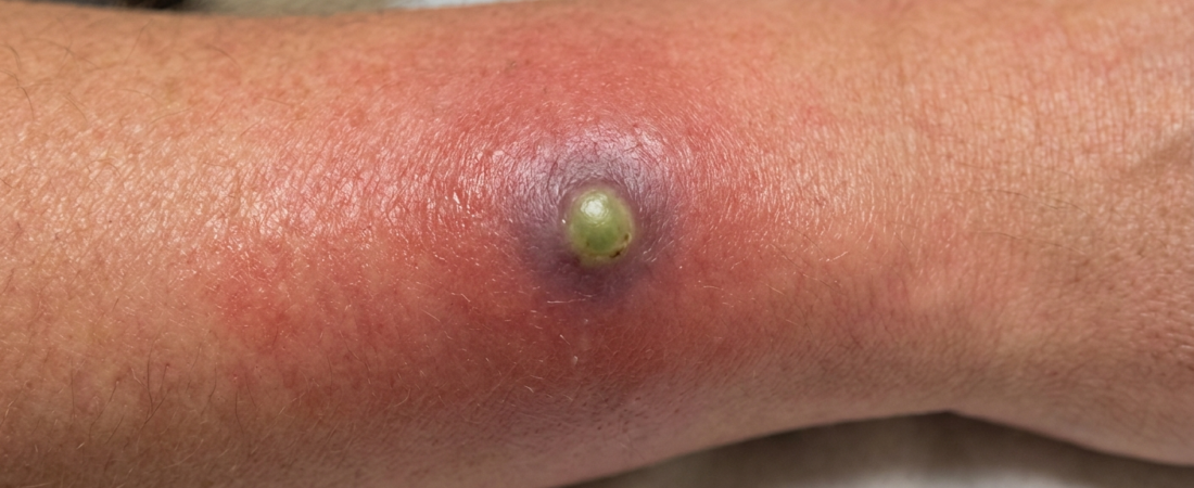 Abscess : Symptoms, Causes & Homoeopathy Medicines