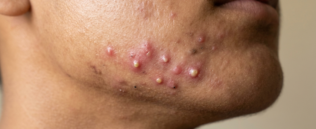 Acne Vulgaris : Symptoms, Causes and Homoeopathy Medicines